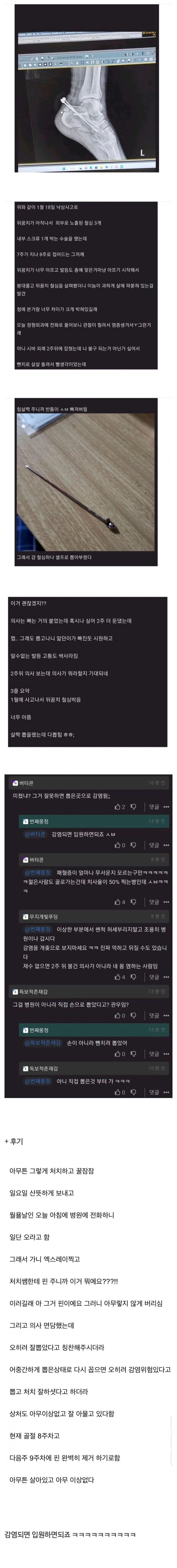 집에서손으로철심뽑은사람.jpeg